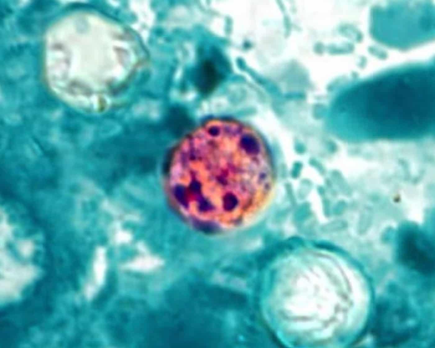 What is cyclosporiasis, the parasitic illness causing ‘explosive’ diarrhea?